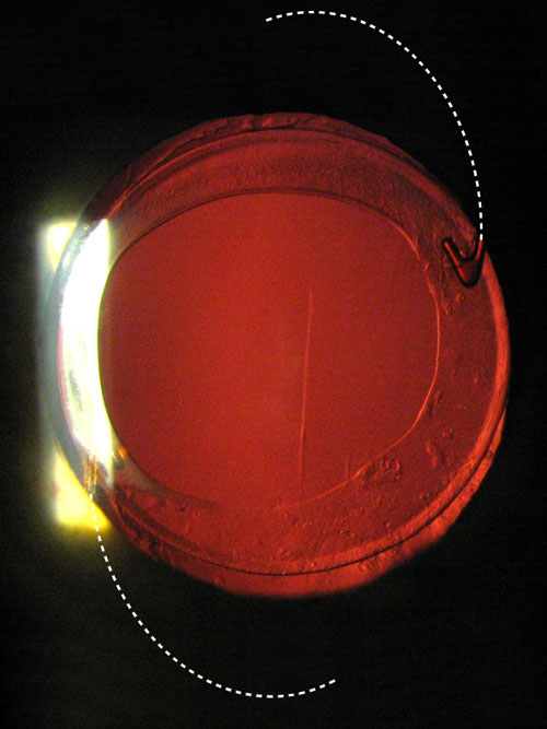 Kathy's retroilluminated eye